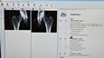 Preview of Operator view of dual-femur during DXA scan